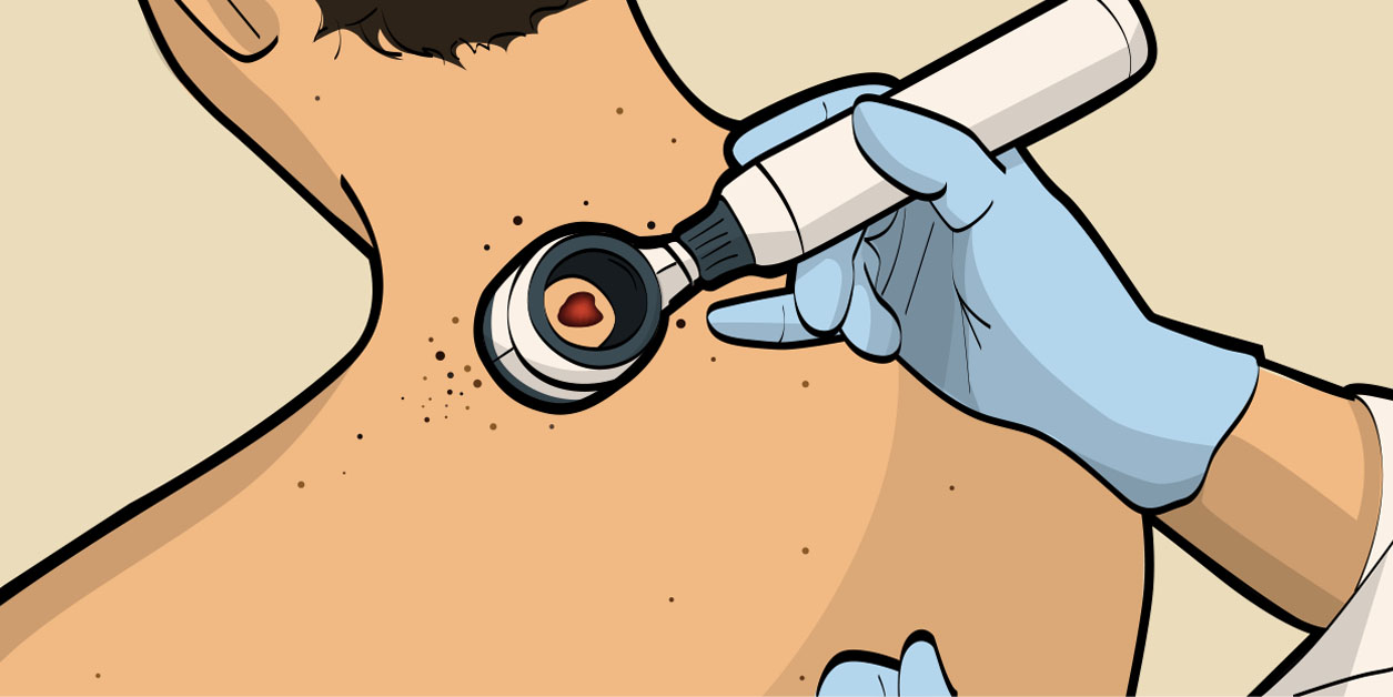 Imagem de capa - Melanoma é o tipo  de câncer de pele  mais perigoso