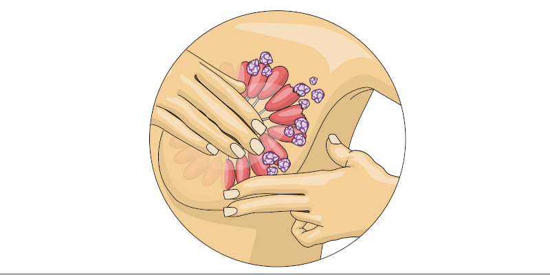 câncer de mama, outubro rosa, assistência médica, mulheres