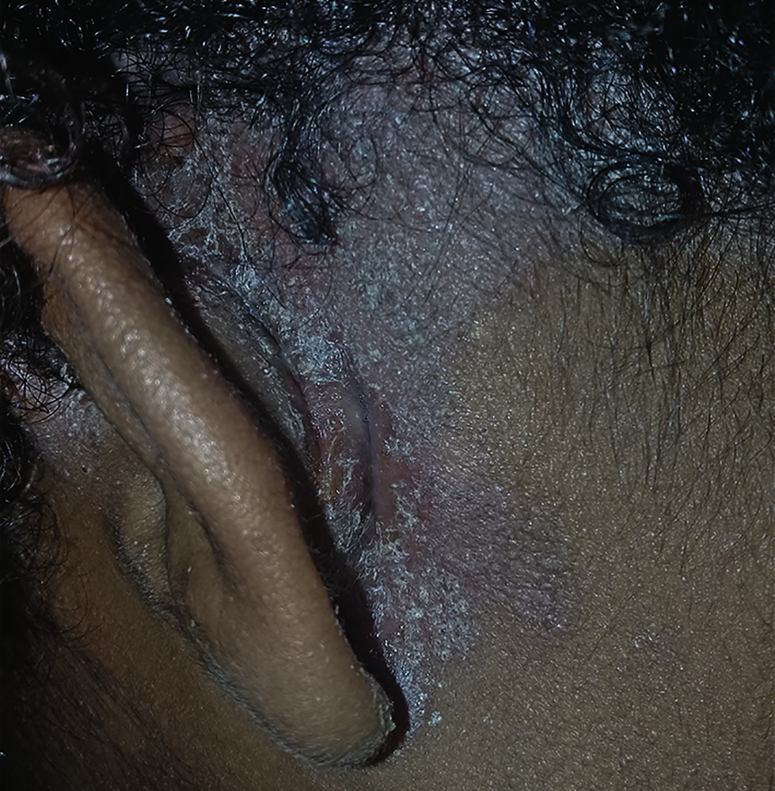 psoríase, doença inflamatória de pele