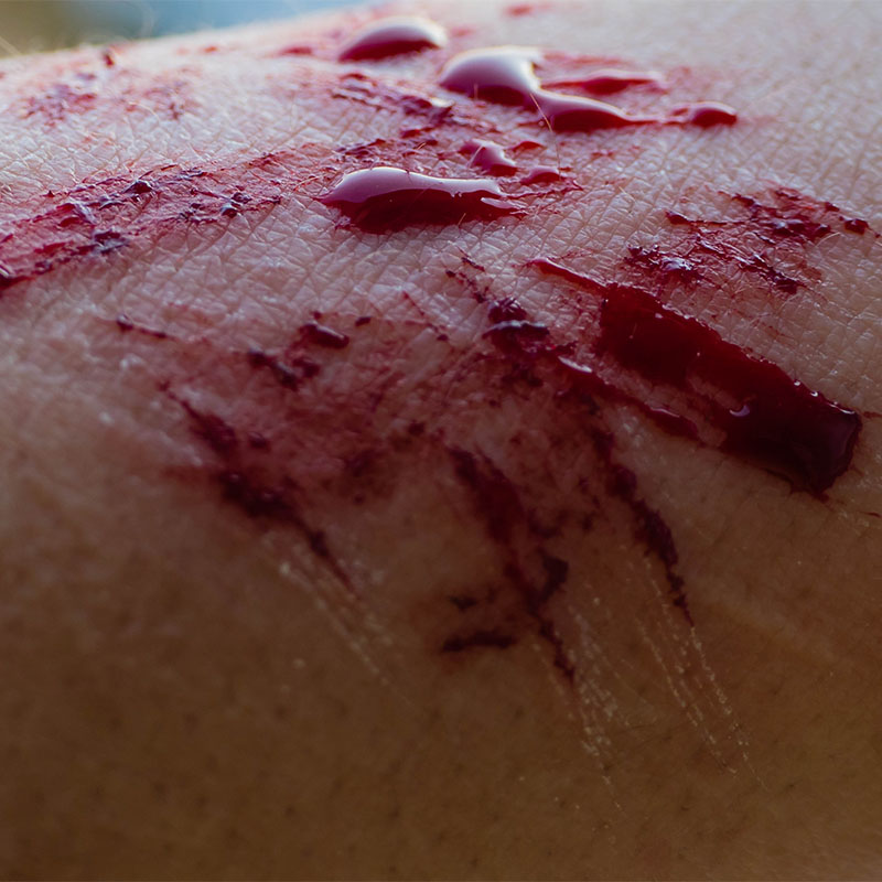Symbolic Borderline Blood on Arm