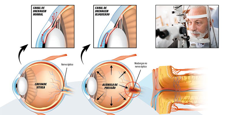 Imagem de capa - Glaucoma pode levar à cegueira