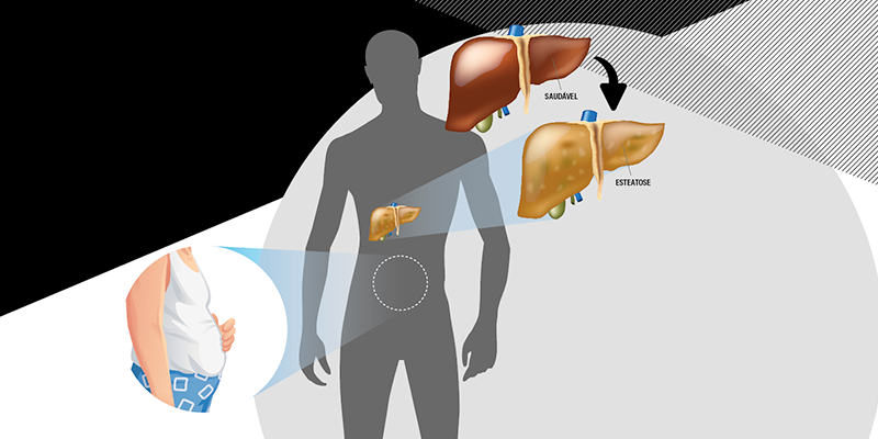 Imagem de capa - Você já ouviu falar de gordura  no fígado?