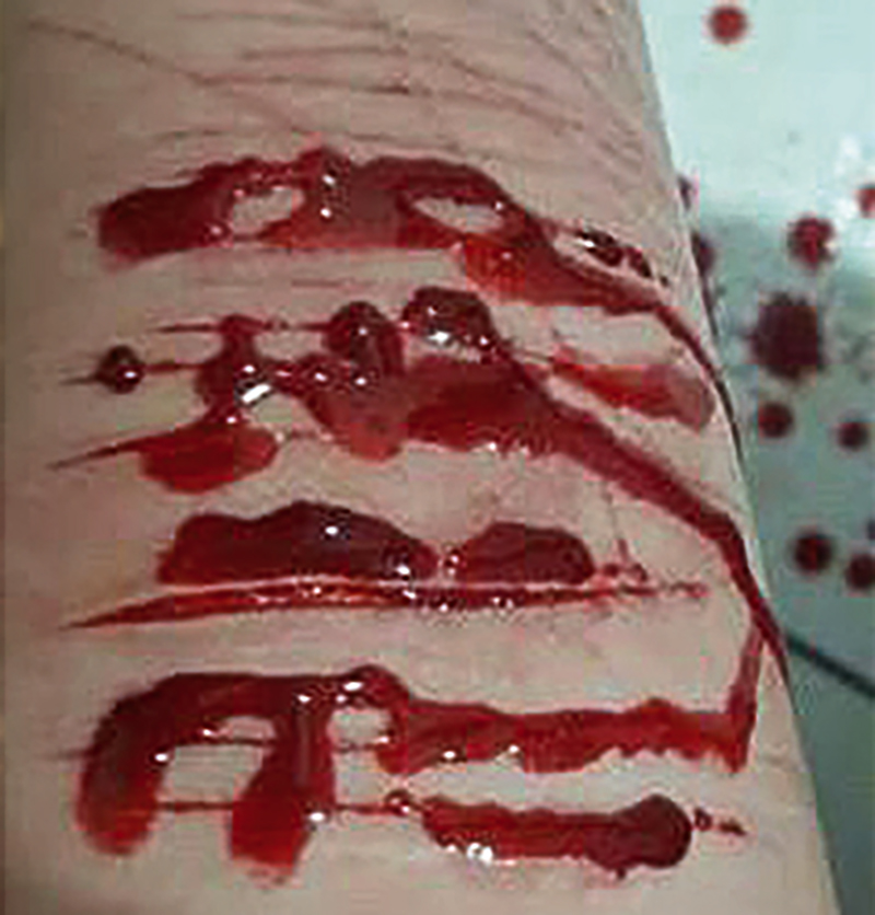 “Com 15 anos comecei  a me automutilar”