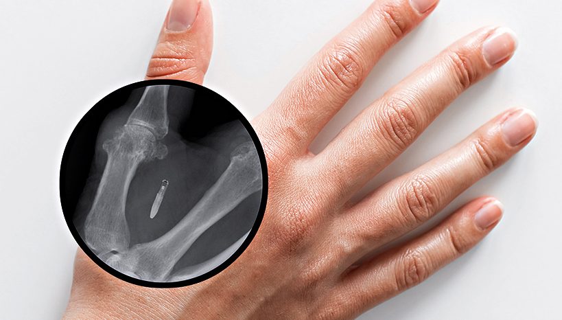 Imagem de capa - Você aceitaria ter seus dados  implantados em sua mão?