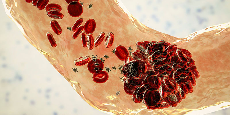 Imagem de capa - Trombose: a doença silenciosa responsável pelo enfarte e pelo AVC