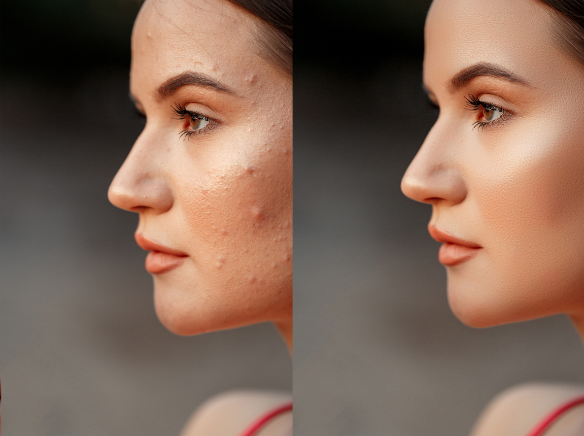 face with acne and pimples close-up. shallow DOF. selective focus. before and after retouching(after applying acne remedies).