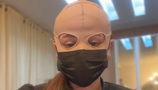 Atacroton peeling químico