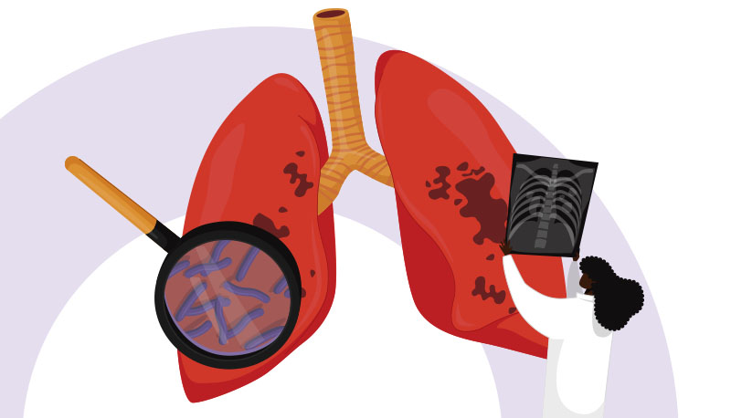 Dia Nacional reforça cuidados e prevenção contra a tuberculose